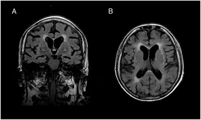 Atypical Autoimmune Encephalitis With Neuropil Antibodies Against a Yet Unknown Epitope